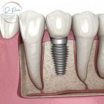 Group logo of Dental Implants Terminology Explained: A Comprehensive Guide